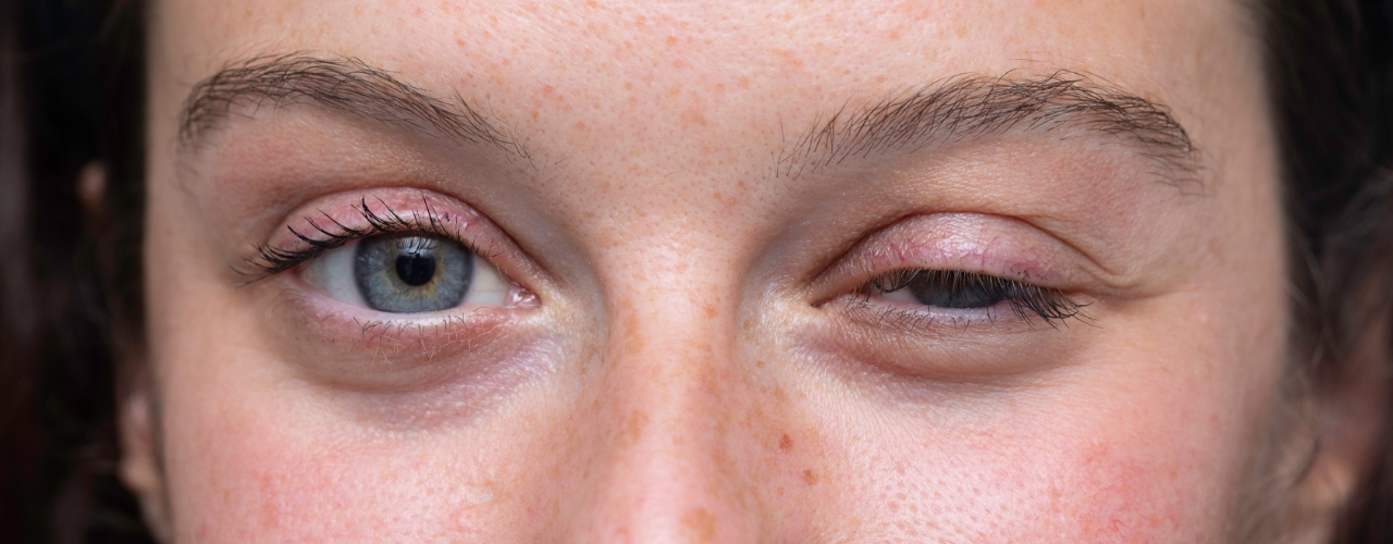 Physical-therapy-clinic-myasthenia-gravis-clearcut-ortho-fort-worth-tx