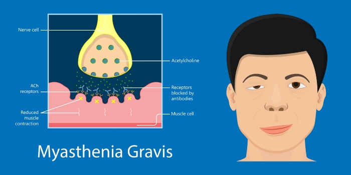 Physical-therapy-clinic-myasthenia-gravis-clearcut-ortho-fort-worth-tx