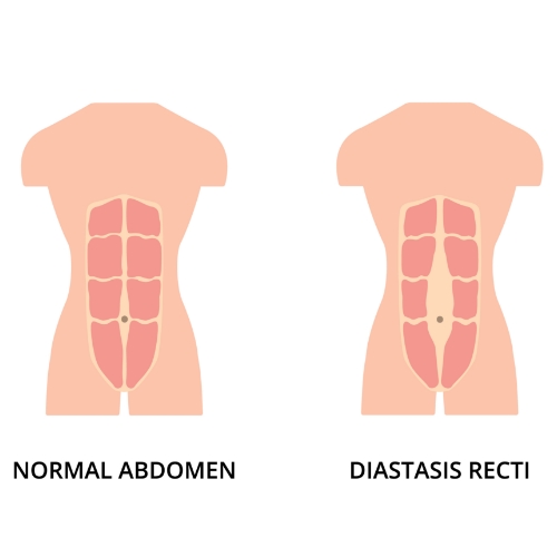 physical-therapy-clinic-diastasis-recti-clearcut-ortho-fort-worth-tx