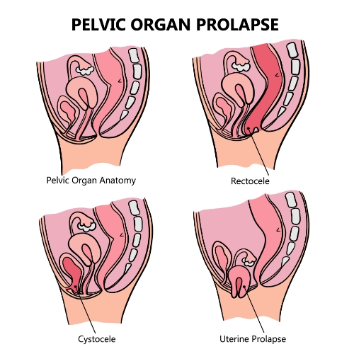 physical-therapy-clinic-prolapse-clearcut-ortho-fort-worth-tx