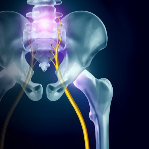 physical-therapy-clinic-sciatica-pain-relief-clearcut-ortho-fort-worth-tx
